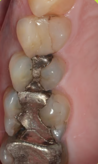 Amalgamas dentales de mercurio