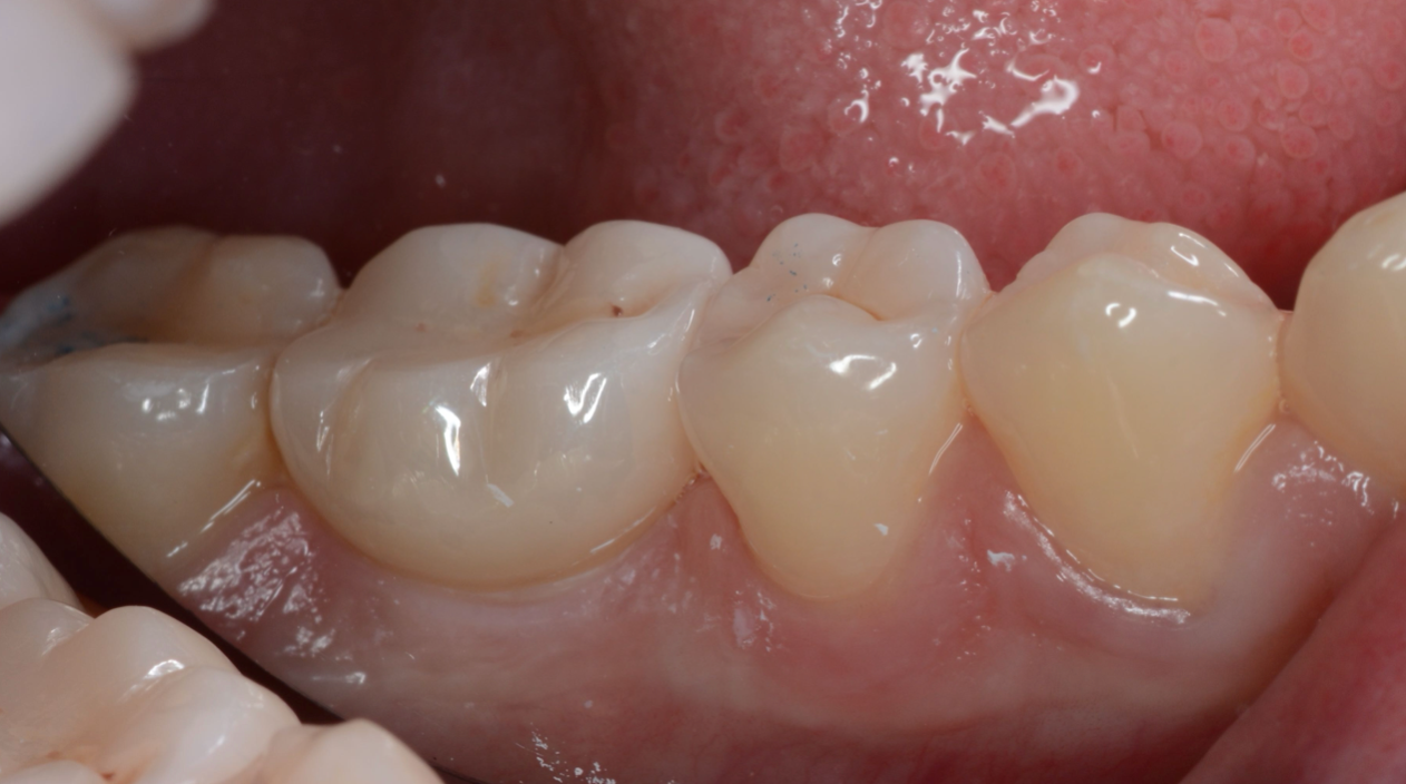Corona sobre implante cerámico