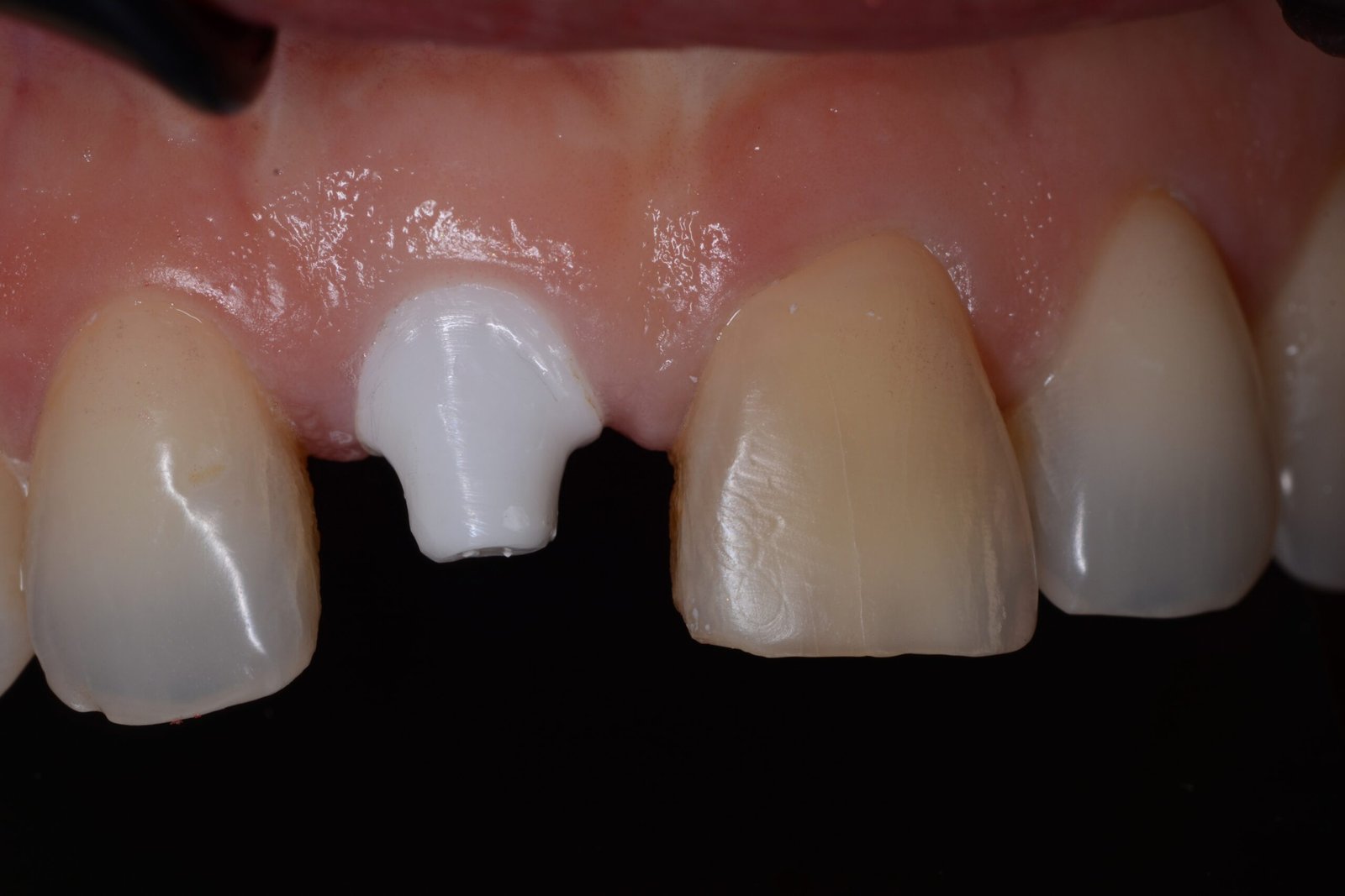 Implantes de zirconio